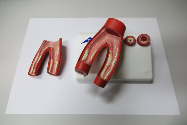 動脈硬化症モデル