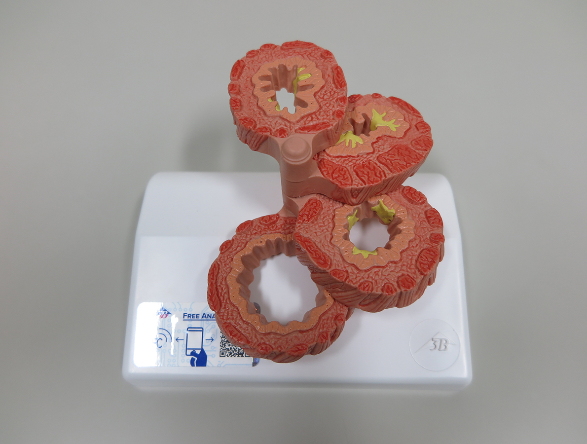 COPDの気管支モデル